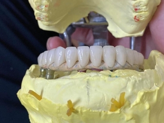 PHỤC HÌNH IMPLANT